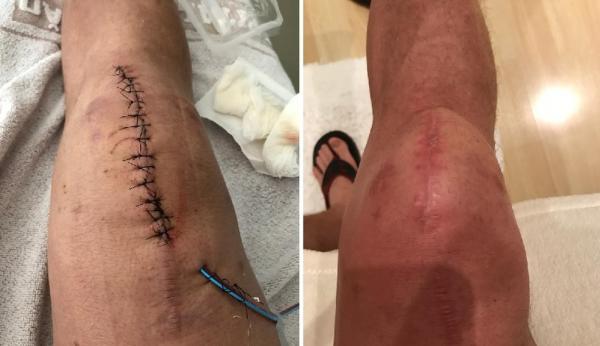 O joelho direito de Marcelo Mattos após uma das cirurgias em 2018; com e depois sem os pontos