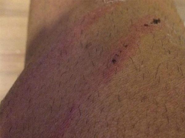 Hernane divulgou foto de sua perna machucada aps a vitria do Flamengo contra o Vasco