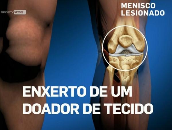 Nova tcnica implanta menisco no lugar de toda rea lesionada