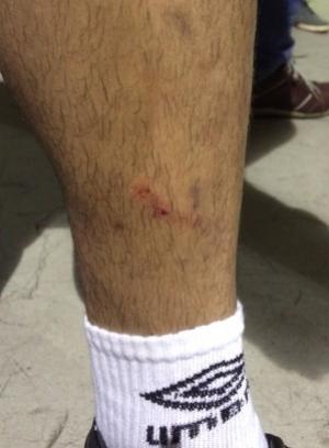 Marca na canela que Gilberto diz ter sido no lance com Diego Cavalieri