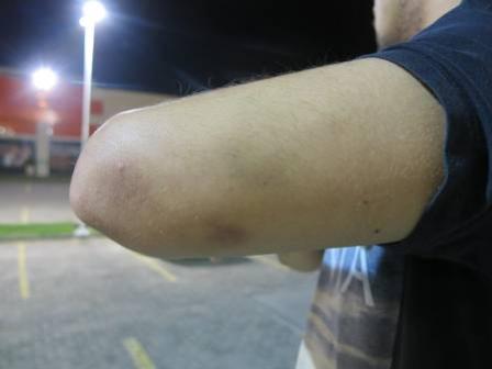 X mostra hematomas que seriam da agressão sofrida no último sábado 