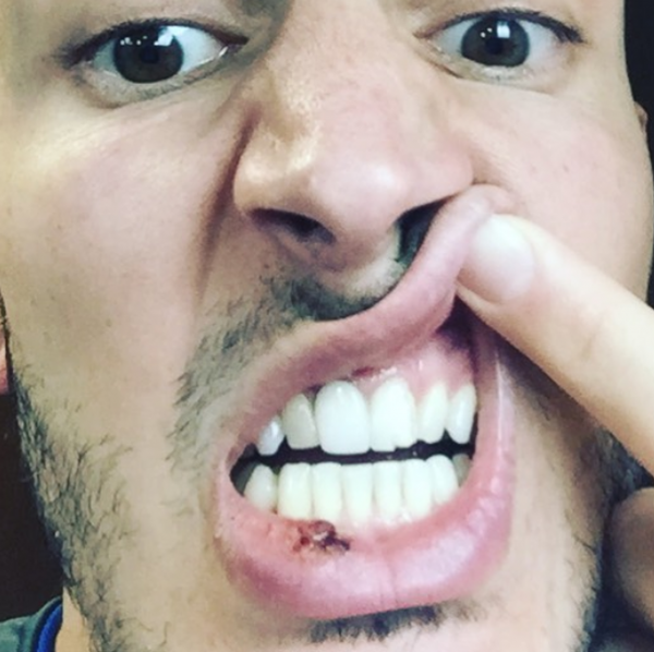 Dedé, do Vasco, mostra dente quebrado e boca ferida