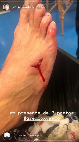 Maxi López mostra em suas redes sociais o corte que teve no pé, na partida contra o Grêmio